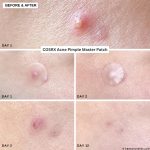 پچ ضدجوش کوزارکس Cosrx Acne Pimple Master 24 patches - تصویر 4